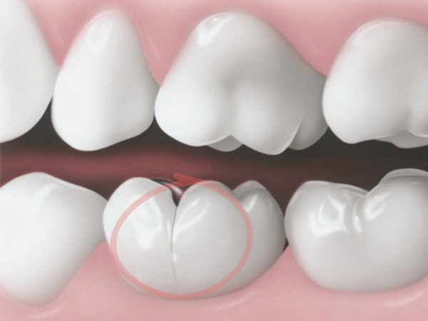 마곡치과_1. 씹을 때 치아 통증, 왜 생길까요? 관련 이미지 2