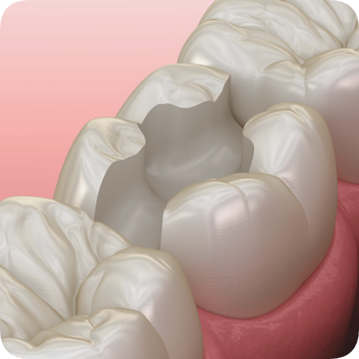 마곡역치과_5. 인레이 보철물 떨어지는 이유 [ 탈락 원인과 재접착 가능한 경우는? ] 관련 이미지 4