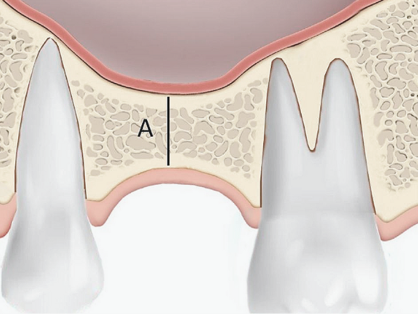 마곡역치과_2. 상악동 거상술 치조정 접근법, 언제 어떻게 진행될까? 관련 이미지 3