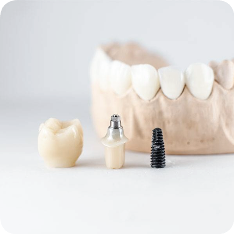 마곡역치과_잃어버린 치아, 그 자리에 다시 &lsquo;내 것 같은&rsquo; 이를! [ 1. 임플란트 기본 구조 ] 관련 이미지 5