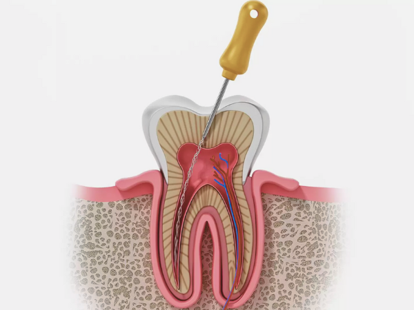 마곡동치과_&ldquo;신경치료했는데 또 아파요?&rdquo; [1. 치근단절제술이 필요한 경우] 관련 이미지 2