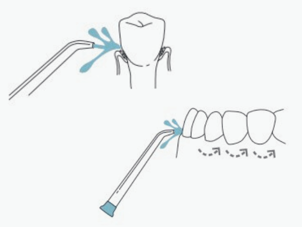 마곡역치과_ 4. 구강세정기 꼭 써야 할까요? 물치실 효과와 올바른 사용법 관련 이미지 5