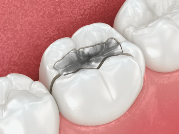 마곡역치과_3. 아말감 왜 검게 변할까요? 충치 신호인지 아닌지  알려드립니다 관련 이미지 3