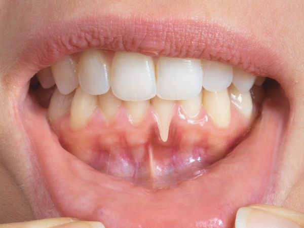 마곡동치과_2. 잇몸재생주사 PDRN, 효과를 기대해도 되는 경우 vs 어려운 경우 관련 이미지 6