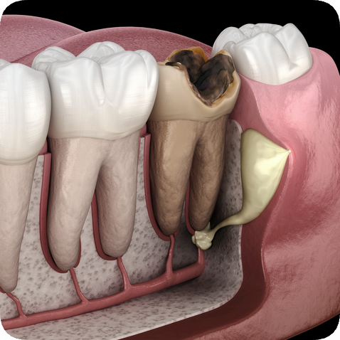 마곡역치과_ 충치, 풍치, 외상으로 치아 빠졌다면? [ 2. 임플란트가 필요한 경우 ] 관련 이미지 1