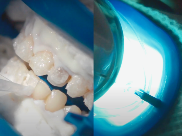 마곡치과_" 짧은 시간, 확실한 톤업" [2. 생활치 전문가 미백치료 특징과 과정 관련 이미지 5