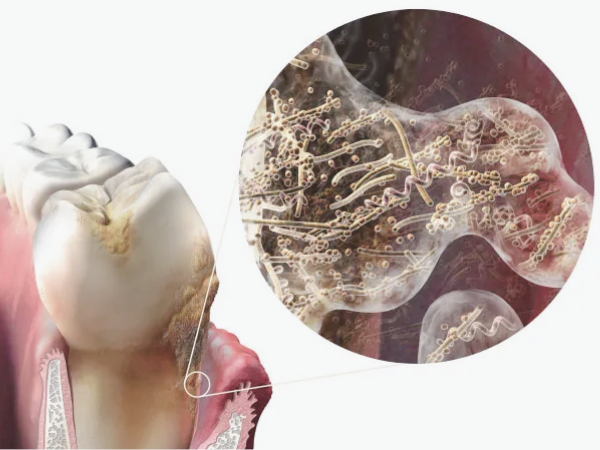 마곡동치과_ 1. 치석 제거는 기본! 스케일링 효과 5가지 총정리 관련 이미지 3