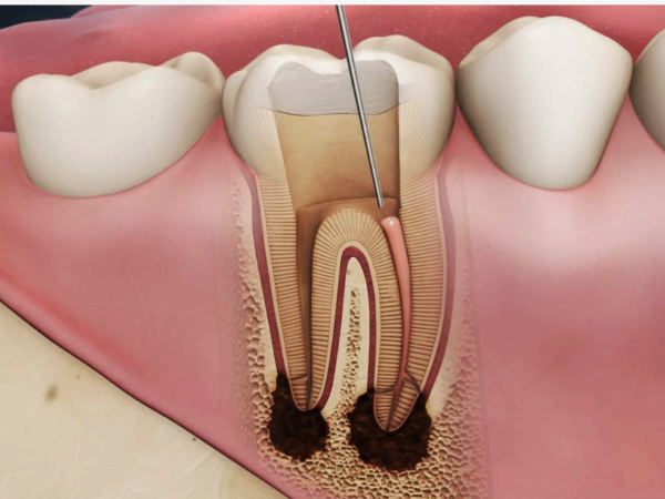 마곡역치과_3. 신경치료 후 통증, 오래가는 경우는 따로 있습니다 관련 이미지 2