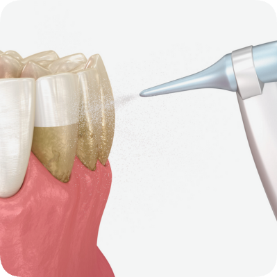 마곡치과_"스케일링에도 스타일이 있다?" [ 3. 에어플로우와 일반 스케일링 비교 ] 관련 이미지 6