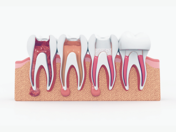 마곡역치과_3. 신경치료 후 통증, 오래가는 경우는 따로 있습니다 관련 이미지 3