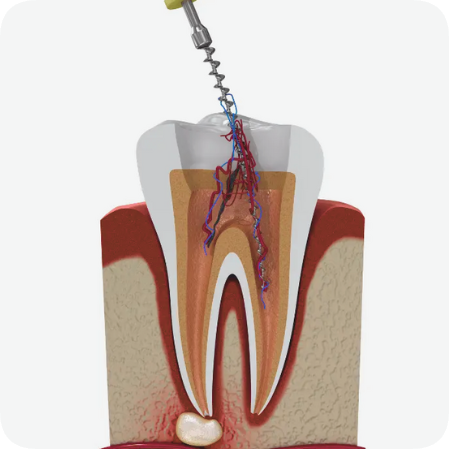 마곡동치과_ "자연치아 지키는 골든타임" [ 1. 신경치료 꼭 받아야 하는 5가지 경우 ] 관련 이미지 2