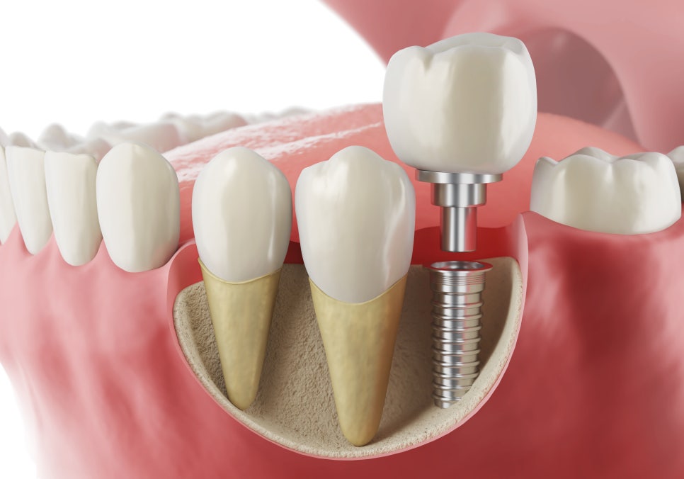 [ Magok Implants_02 ] Immediate Implants After Extraction: When They Are Possible and When They Are Risky image 1