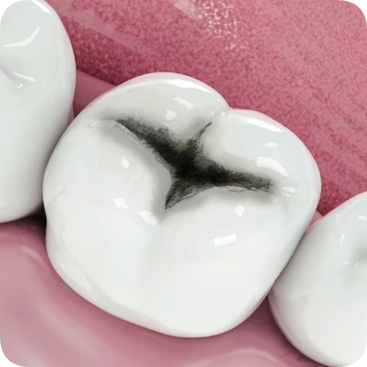 마곡동치과_1. 인레이 보철 치료, 언제 필요한가요?[ 치료 시기와 증상 정리 ] 관련 이미지 4