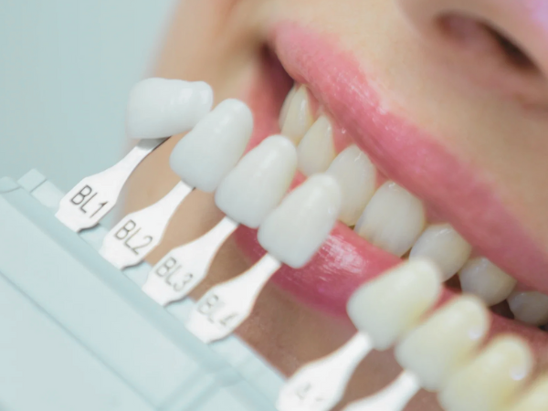 마곡역치과_ &ldquo;집에서 하얀 치아 만들기!&rdquo;[3. 생활치 자가미백 치료 특징과 과정 ] 관련 이미지 3