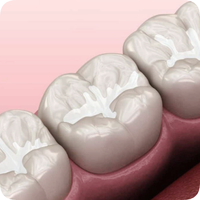 마곡치과_"이럴 땐 레진이 답입니다" [ 1. 치과 레진 활용법 ] 관련 이미지 7
