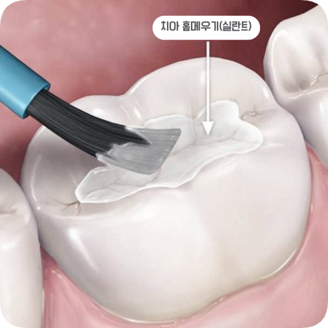 마곡동치과_"지금 바로 실천하세요!" [ 5. 충치 예방 관리법 ] 관련 이미지 4