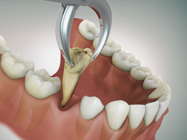 [마곡동치과_치아 흔들림 시리즈1] 흔들리는 이빨, 왜 생길까요? 관련 이미지 6