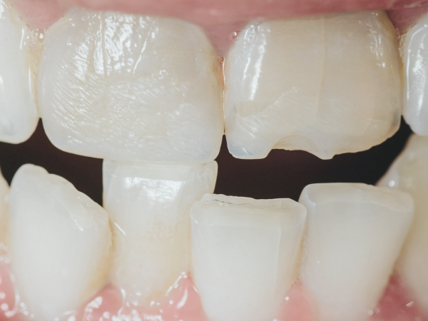마곡역치과_&ldquo;괜찮겠지 했다가 더 커집니다&rdquo;[4. 금간 치아 방치 시 발생하는 문제] 관련 이미지 1
