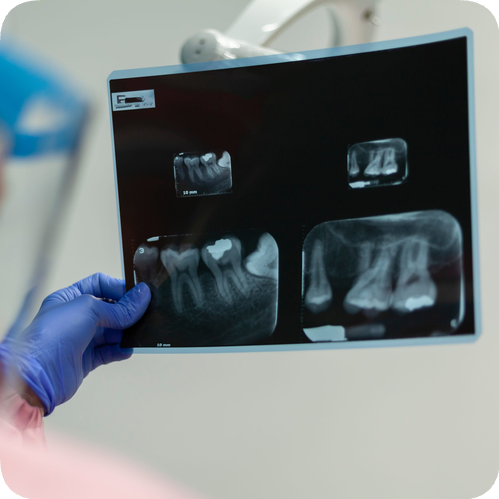 마곡역치과_ &ldquo;죽은 치아도 다시 하얘진다!&rdquo; [4. 실활치 미백치료 특징과 과정] 관련 이미지 3