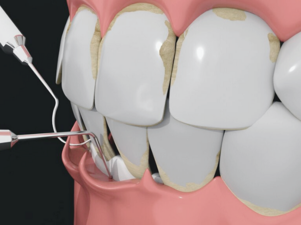 Maggok Dental_3. Gum Surgery: When Periodontal Flap Surgery Is Needed and the Treatment Process image 2