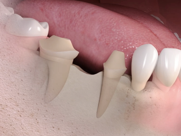 마곡동치과_1. 브릿지 치료란 무엇인가요? 임플란트, 틀니와 차이부터 정리합니다 관련 이미지 7