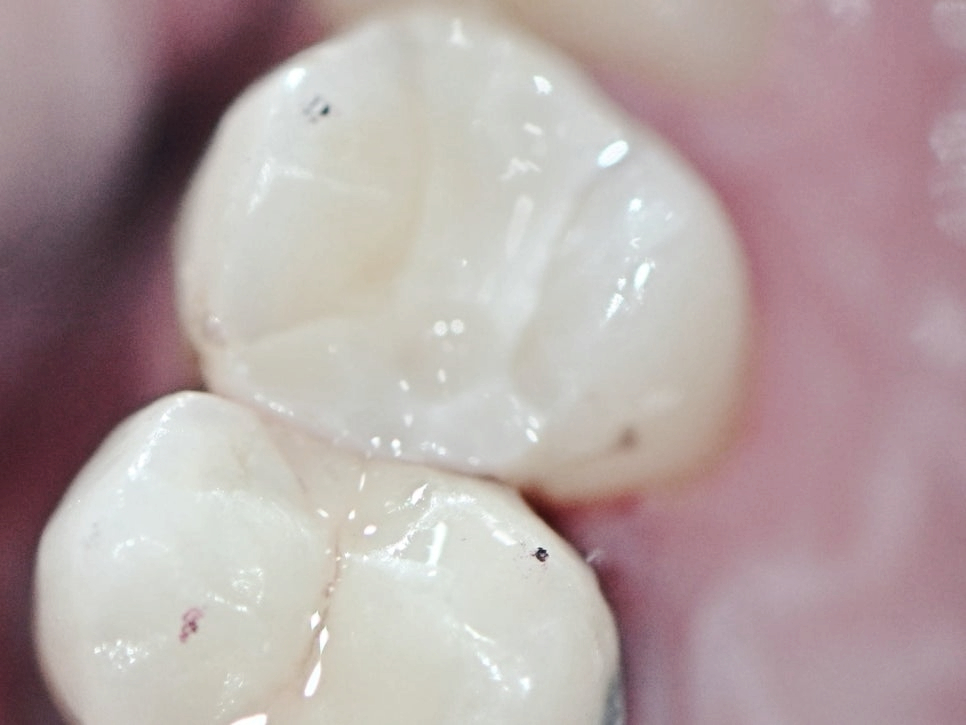 마곡동치과_3. 인레이 치료 과정과 소요 시간 (feat. 저스트 스캔) 관련 이미지 5