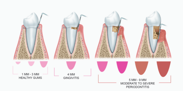 마곡동치과_4. 치주질환 진단검사로 잇몸병 진행 정도 바로 확인하세요! 관련 이미지 2