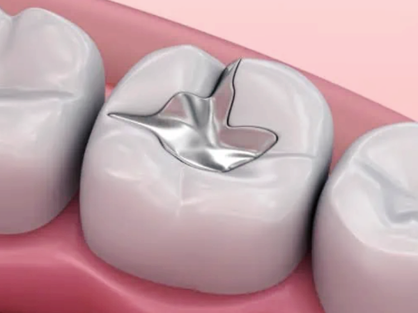 마곡치과_2. 오래된 아말감, 언제 교체해야 할까요? 꼭 확인해야 할 5가지 신호 관련 이미지 2