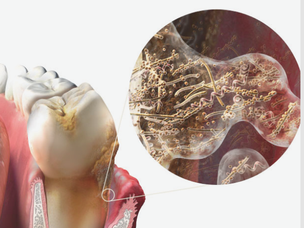 Maggok Dental_2. Why root planing and curettage are needed when scaling is not enough image 4