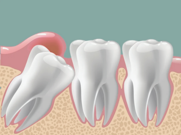 마곡동치과_7. 사랑니 발치 후 생기는 드라이소켓, 원인과 증상부터 예방법까지 총정리 관련 이미지 5