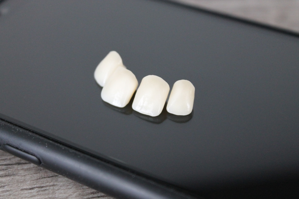 [ Magok Veneers_07 ] Veneer Failure Cases: Be Careful in These Situations image 1