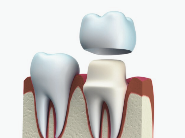 마곡역치과_ &ldquo;참지 말고 잡자!&rdquo; [ 2. 시린이(지각과민증) 치료 ] 관련 이미지 5