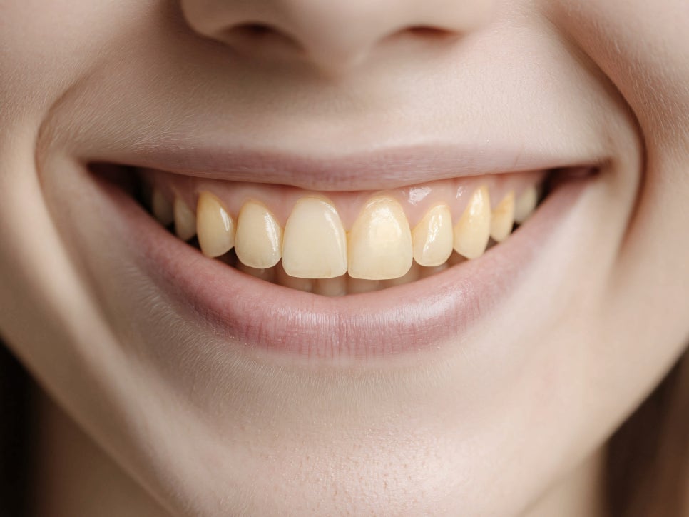 마곡치과_  1. 무삭제 라미네이트가 가능한 경우 ( feat. 디아네이트) 관련 이미지 7