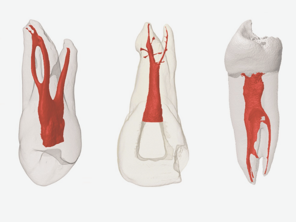 마곡동치과_&ldquo;신경치료했는데 또 아파요?&rdquo; [1. 치근단절제술이 필요한 경우] 관련 이미지 4