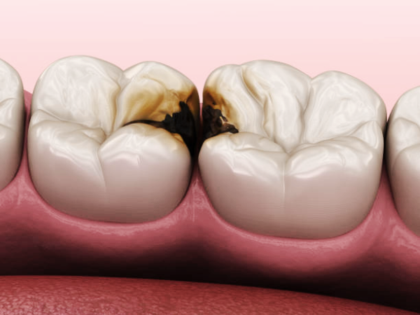 마곡역치과_&ldquo;불소도 다 똑같지 않아요!&rdquo;[2. 불소 종류와 상황별 선택법] 관련 이미지 6