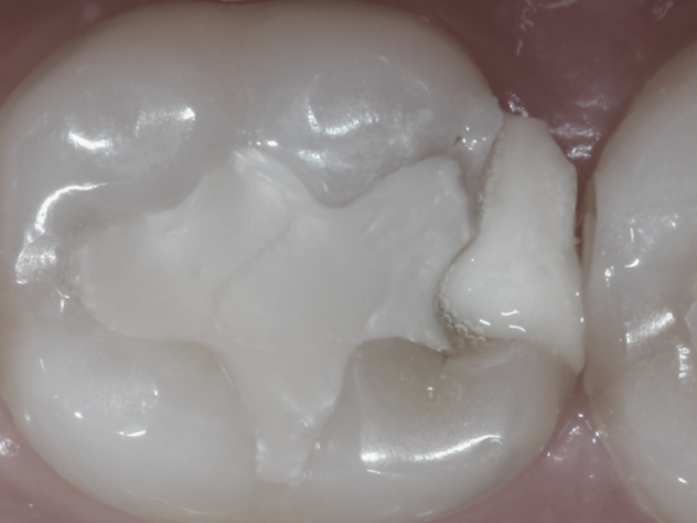 마곡동치과_5. 중년기 초입(30~40대) 치아 잇몸 변화와 구강관리 포인트 관련 이미지 4