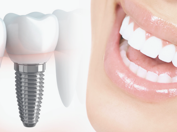 마곡동치과_ "오늘 뽑고 심는 임플란트, 정말 괜찮을까?" [ 2. 당일 임플란트 장점 단점 ] 관련 이미지 3