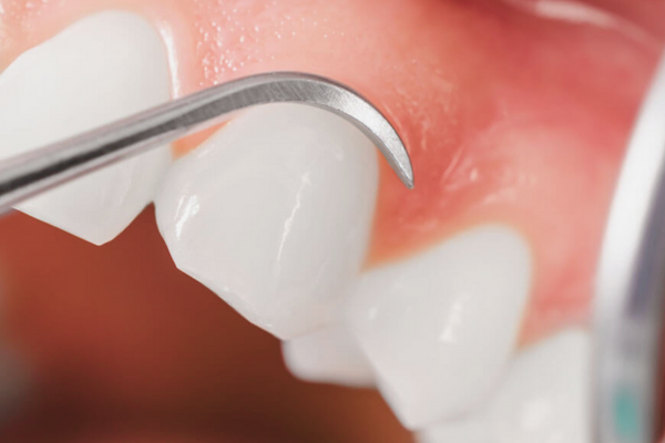 마곡역치과_ 하얀 치아로 가는 가장 빠른 길! [ 3. 생활치 전문가 미백의 특징과 과정 ] 관련 이미지 3