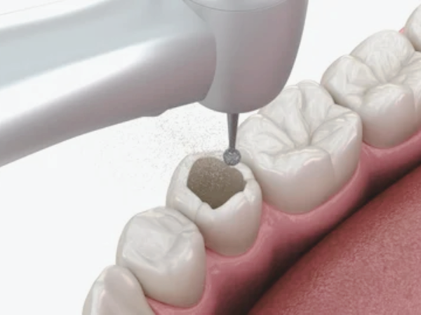 마곡역치과_ "신경치료 후 치아, 왜 꼭 &lsquo;씌워야&rsquo; 할까요?" [7. 크라운 보철의 중요성] 관련 이미지 2