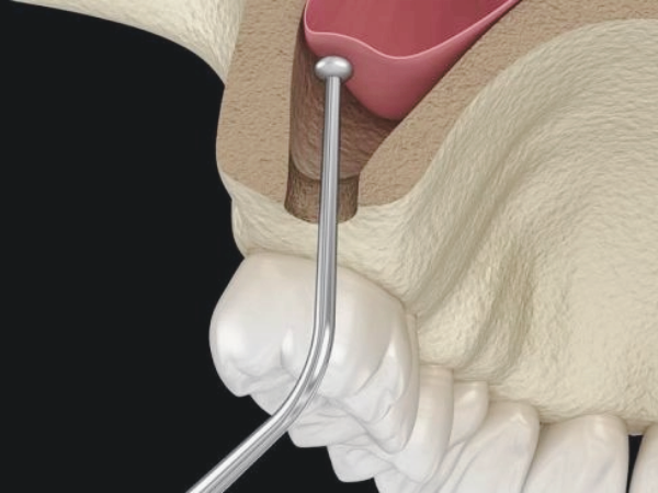 마곡역치과_1. 상악동거상술이란? 위턱 임플란트 전 꼭 알아야 할 정의와 적응증 관련 이미지 3