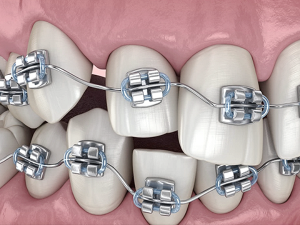 Maggok Station Dental Clinic_ “When Is the Right Time?” [2. Timing and Cost of Pit and Fissure Sealants] image 2
