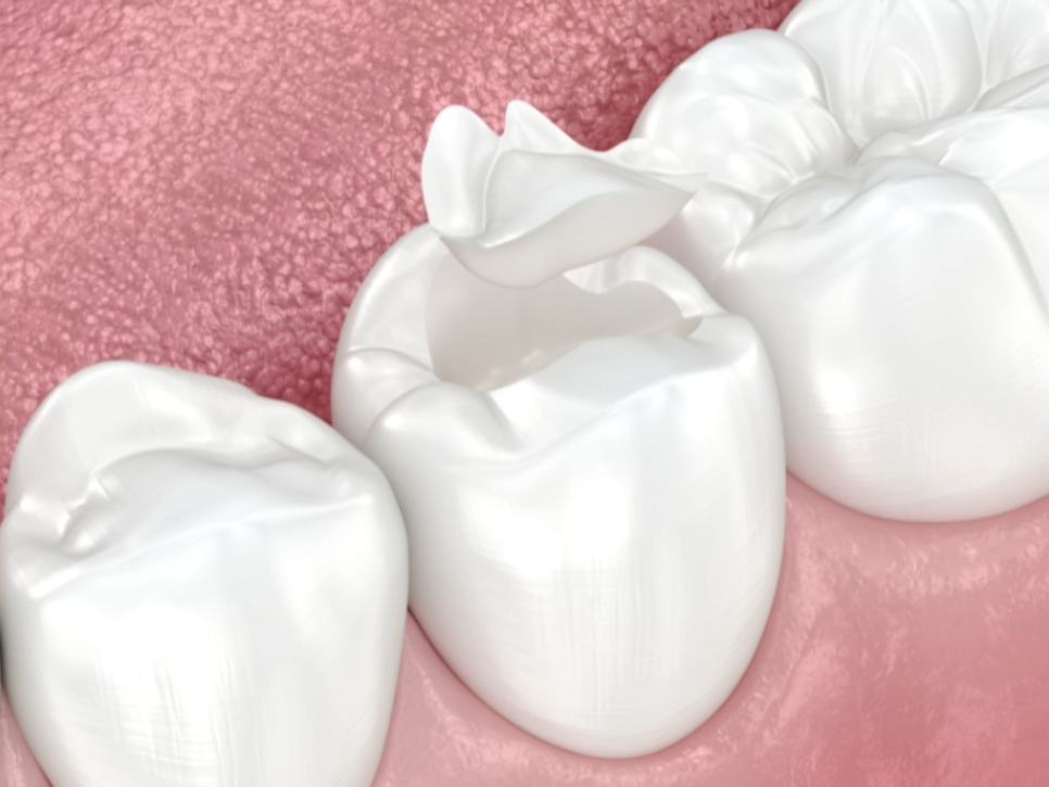 마곡 치과_ 당일 인레이 보철 셋팅 시스템을 소개합니다.( feat. 저스트 스캔) 관련 이미지 8