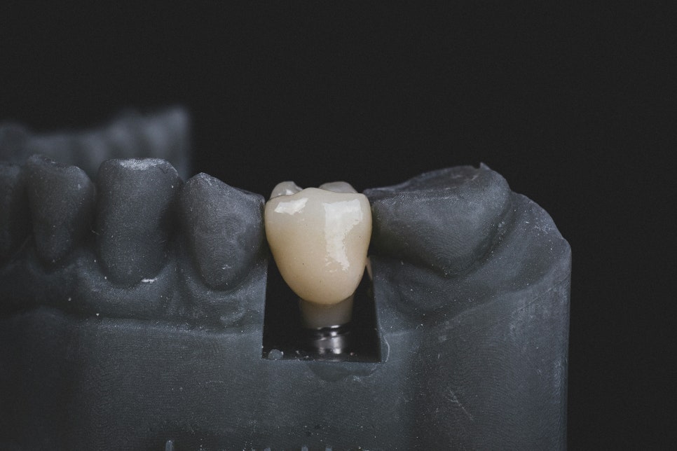[ Magok Implants_06 ] Can Implant Surgery Be Completed in One Visit? Number of Visits by Stage image 2