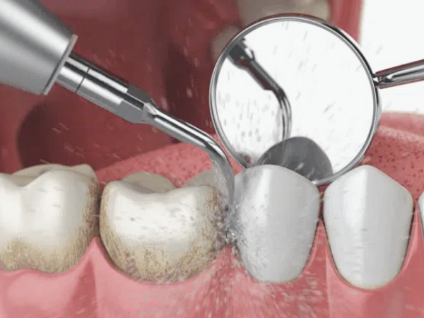 마곡동치과_3. 스케일링 비용, 건강 보험 적용되나요? 1년에 한 번 혜택 총정리 관련 이미지 1