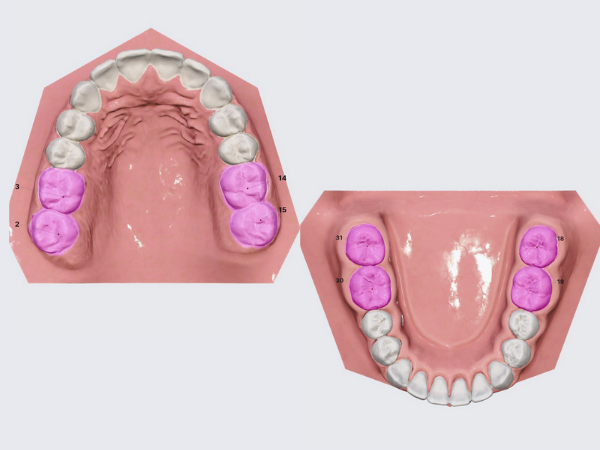 Maggok Station Dental Clinic_ “When Is the Right Time?” [2. Timing and Cost of Pit and Fissure Sealants] image 1