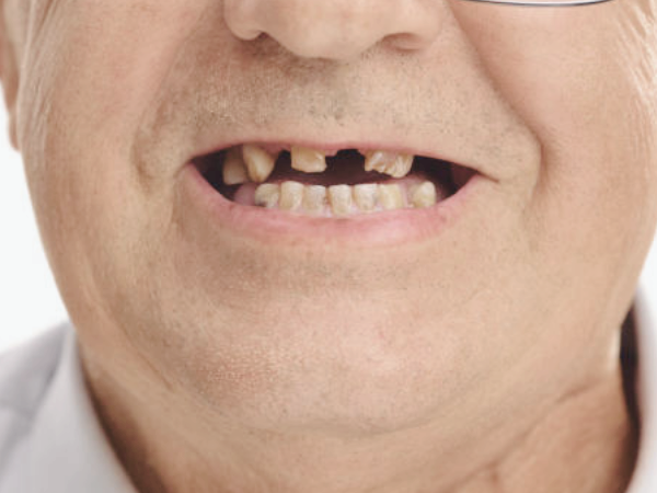 마곡역치과_&ldquo;겉은 멀쩡한데 왜 찌릿할까?&rdquo;  [1. 치아 금(균열) 생기는 이유 ] 관련 이미지 7