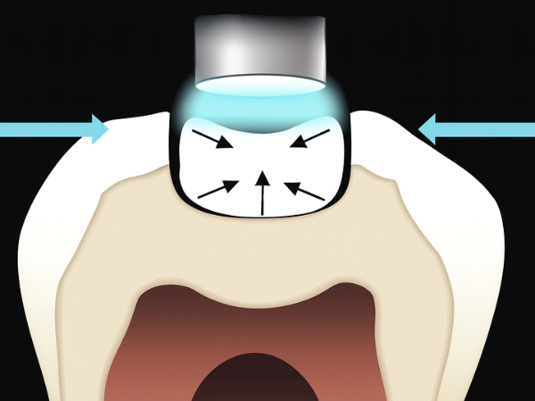 마곡역치과_&ldquo;치료 후 시린 치아, 그냥 두면 될까요?&rdquo; [ 5. 레진 통증 원인과 대처법 ] 관련 이미지 2