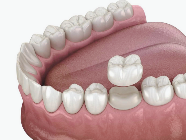 마곡치과_5. 재신경치료 후 주의사항, 치료 후 관리가 더 중요합니다 관련 이미지 4