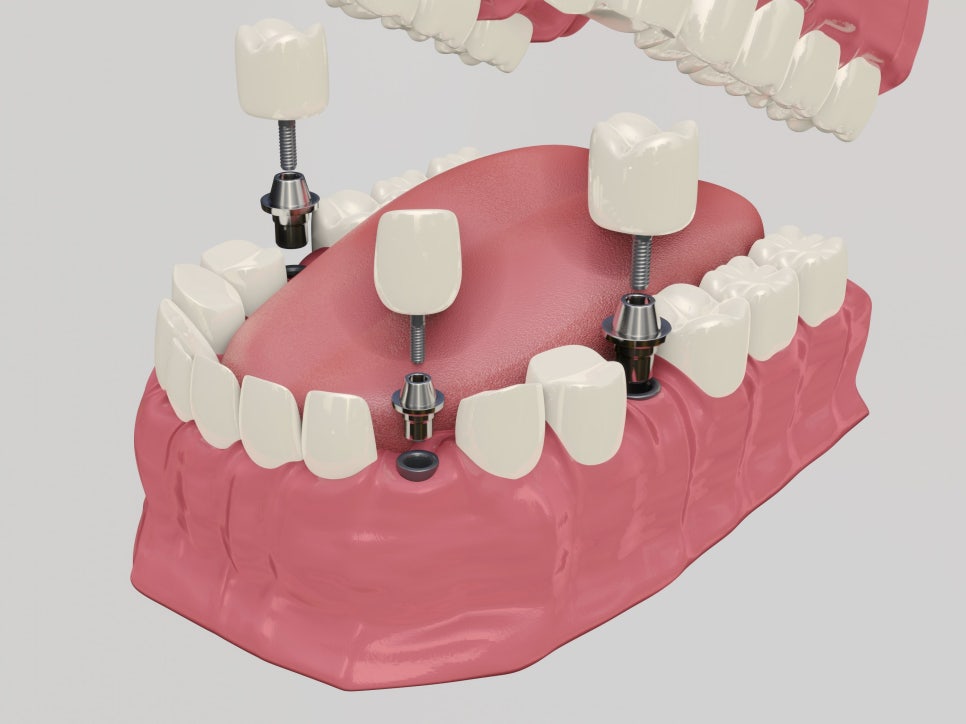 마곡역치과_5.임플란트 수술 후 통증, 붓기의 정상과 위험 신호 기준 관련 이미지 1