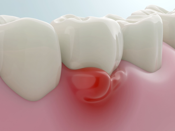 마곡동치과_3. 양치 열심히 하는데 음식이 낀다면? 치간칫솔이 필요한 신호일 수 있습니다 관련 이미지 3